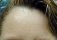 BOTOX Cosmetic Results Connecticut