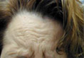 BOTOX Cosmetic Results Connecticut