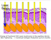 The MiXto Difference from Fractional CO2 Lasers