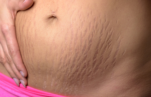 Stretch Marks on the Stomach