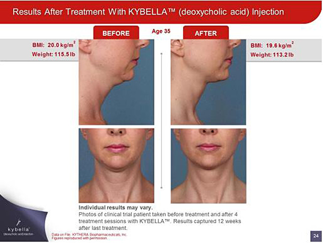 Kybella™ Before and After Photos 