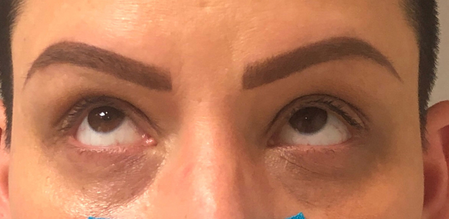 Eye Rejuvenation Results Connecticut
